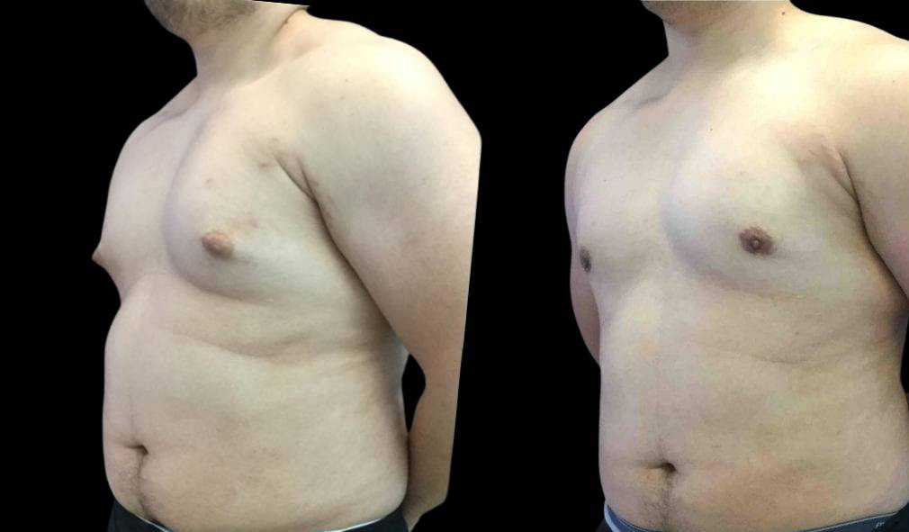 29-year-old-male-breast-reduction-before-and-after-three-quarter-view.jpg