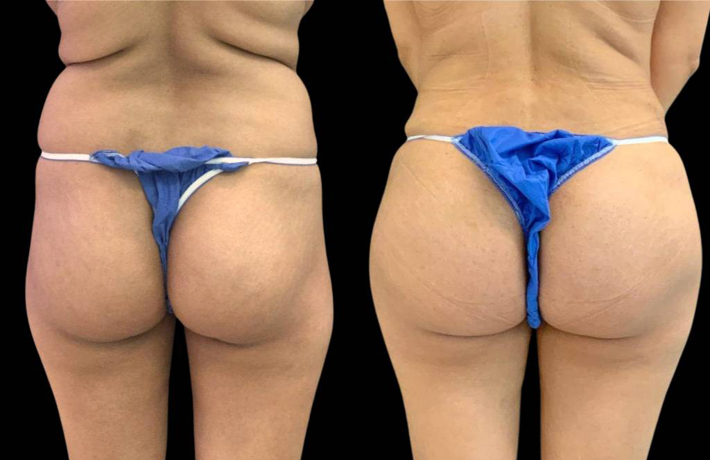 This is a 30-year-old female that has had a brazilian butt lift showing the before and after's side-by-side