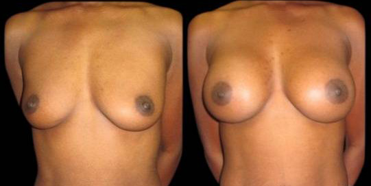 This is a 30-year-old female that has had a breast augmentation and implant showing the before and after's side-by-side