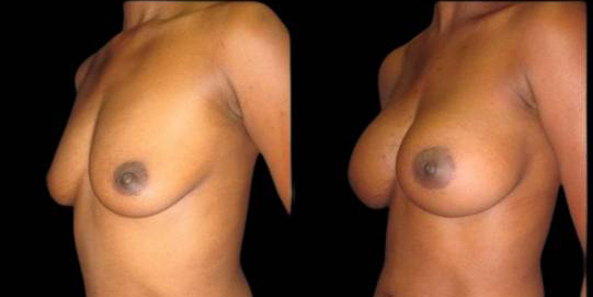 This is a 30-year-old female that has had a breast augmentation and implant showing the before and after's side-by-side