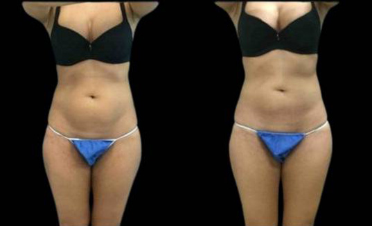 30-year-old-female-coolsculpting-before-and-after-front-view.jpg