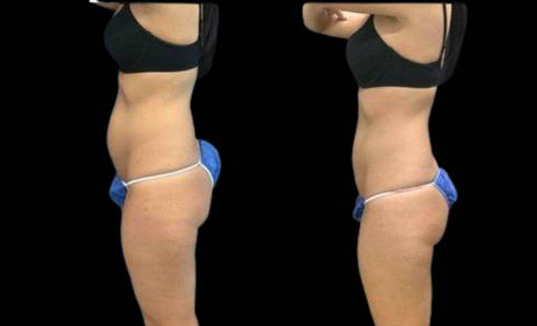 30-year-old-female-coolsculpting-before-and-after-side-view.jpg