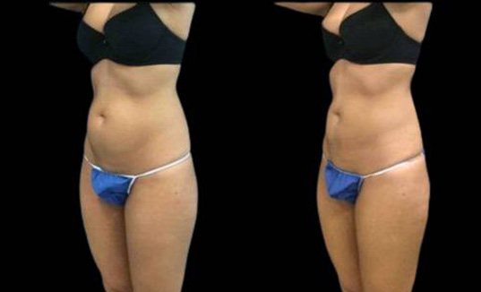 30-year-old-female-coolsculpting-before-and-after-three-quarter-view.jpg