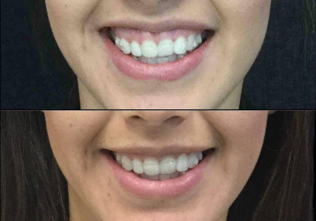 30-year-old-female-gummy-smile-reduction-before-and-after.jpg