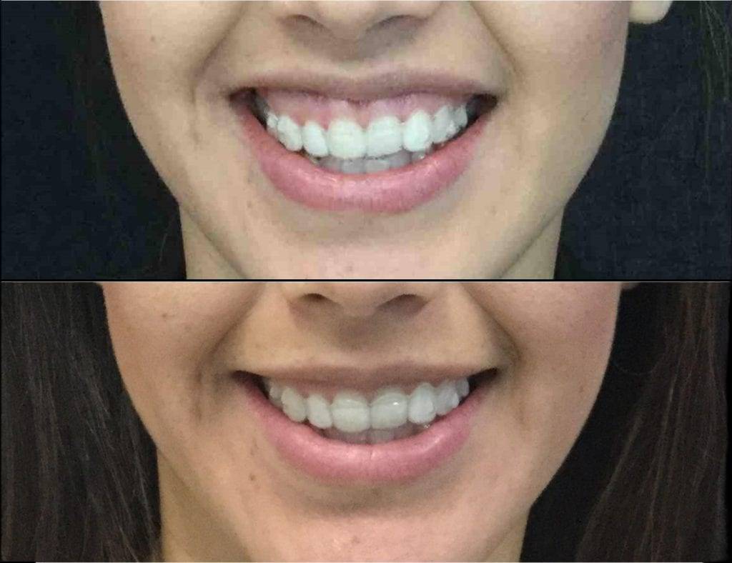30-year-old-female-gummy-smile-reduction-before-and-after