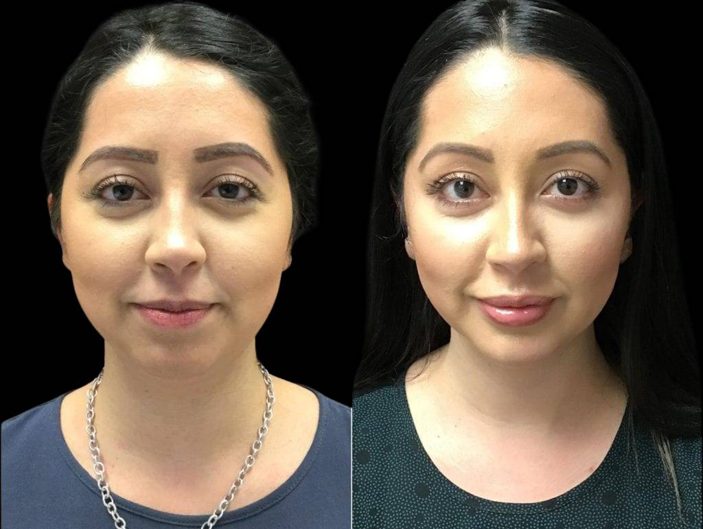 30-year-old-female-model-lift-before-and-after-front-view.jpg