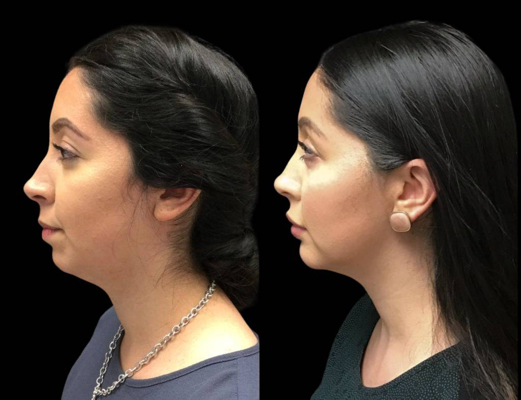 30-year-old-female-model-lift-before-and-after-side-view.jpg