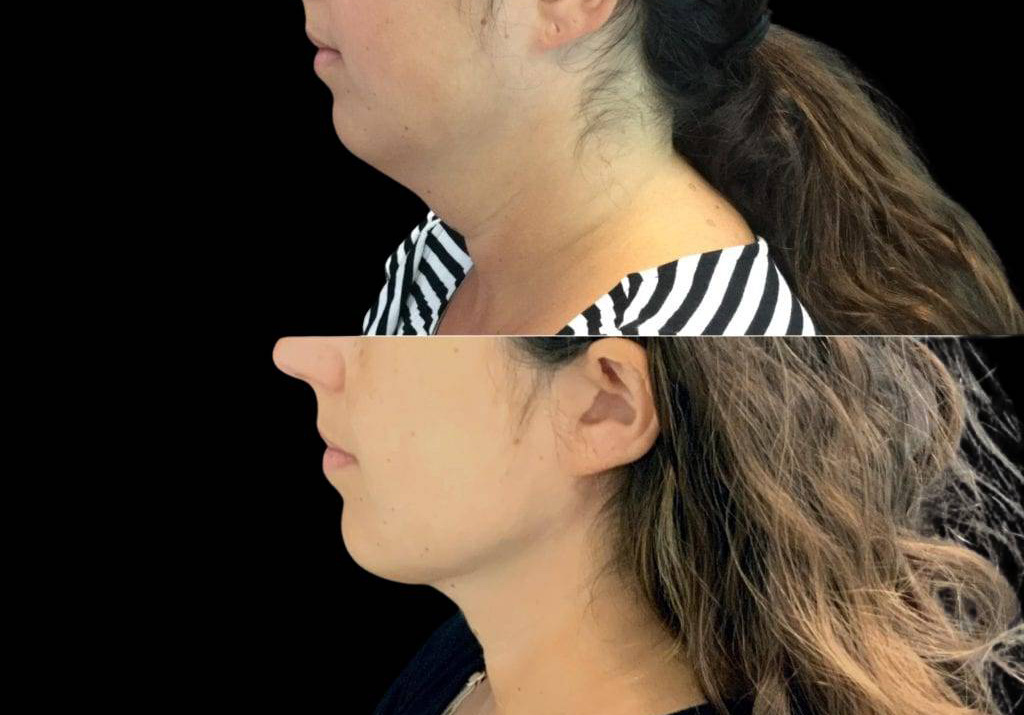 30-year-old-female-neck-liposuction-before-and-after-side-view-29758.jpg