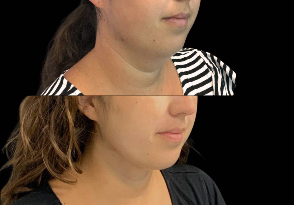 30-year-old-female-neck-liposuction-before-and-after-three-quarter-view.jpg