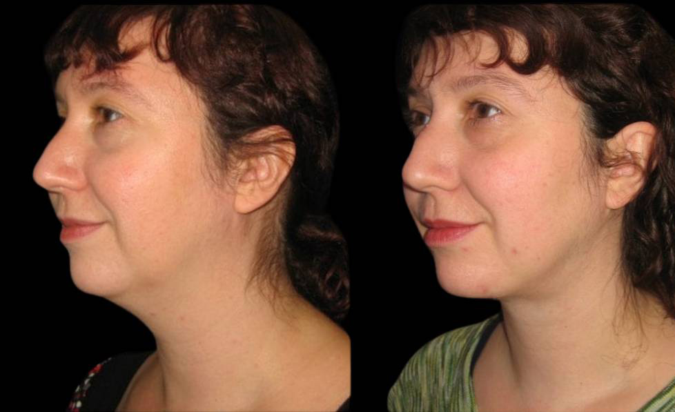 30-year-old-female-necklift-before-and-after-three-quarter-view.jpg