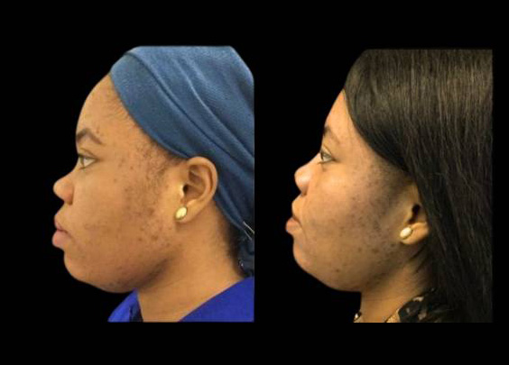 30-year-old-female-non-surgical-rhinoplasty-side-view.jpg