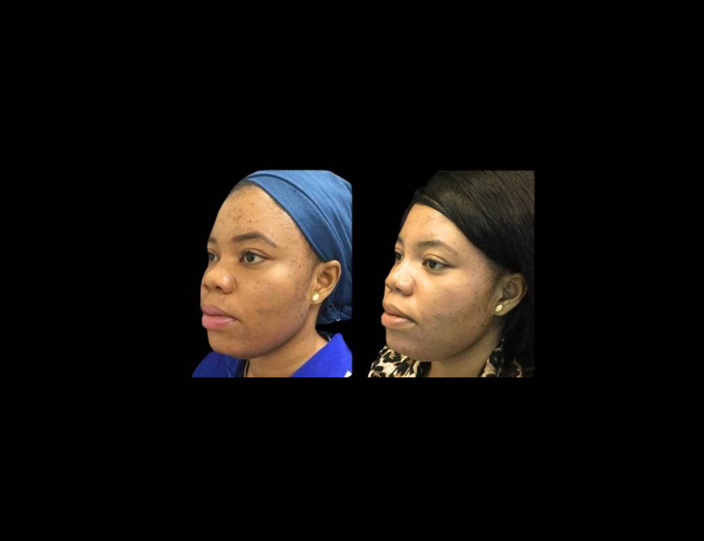 30-year-old-female-non-surgical-rhinoplasty-three-quarters-view.jpg