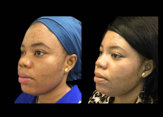 30-year-old-female-non-surgical-rhinoplasty-three-quarters-view.jpg