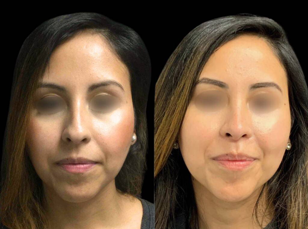 30-year-old-female-rhinoplasty-before-and-after-front-view-3.jpg
