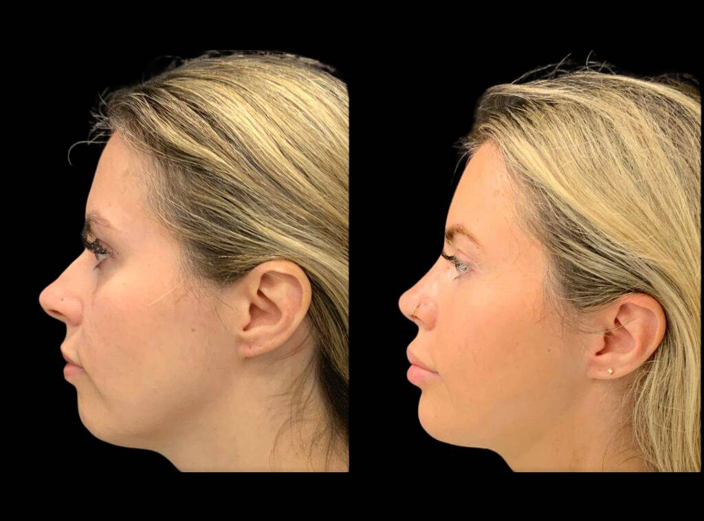 30-year-old-female-rhinoplasty-before-and-after-side-view-3.jpg