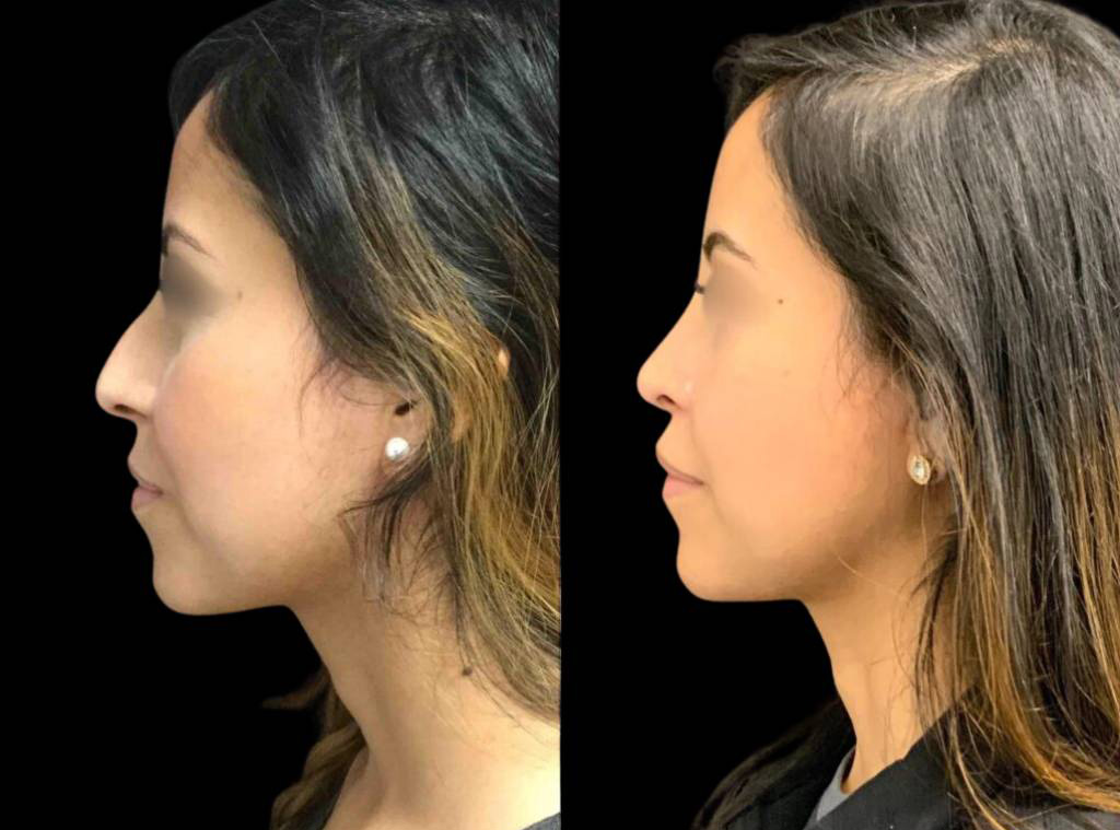 30-year-old-female-rhinoplasty-before-and-after-side-view-4.jpg