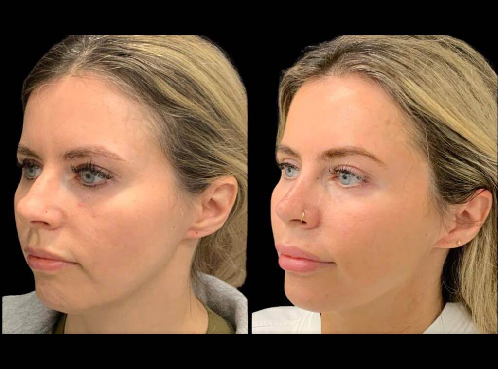 30-year-old-female-rhinoplasty-before-and-after-three-quarters-view-1.jpg