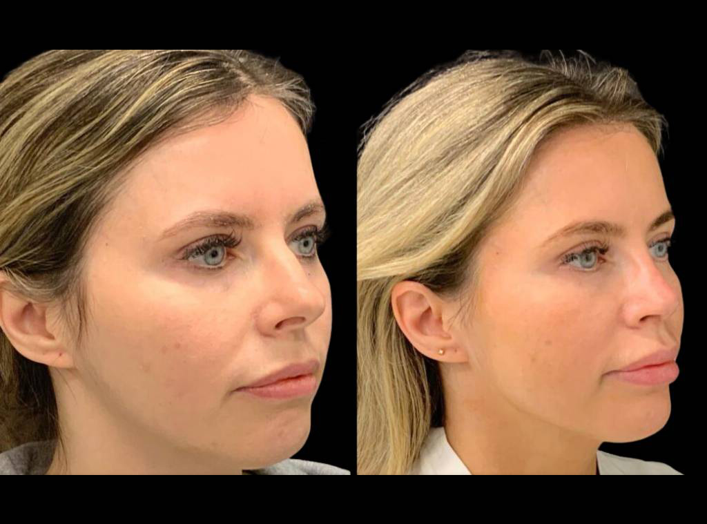 30-year-old-female-rhinoplasty-before-and-after-three-quarters-view-2-1.jpg
