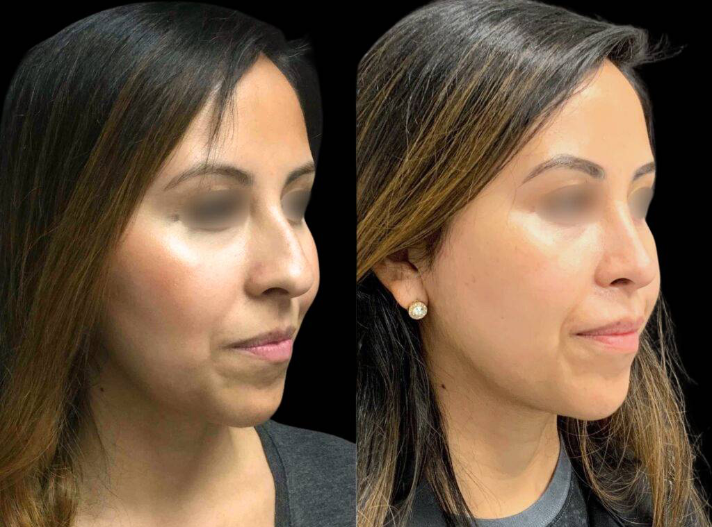30-year-old-female-rhinoplasty-before-and-after-three-quarters-view-3.jpg