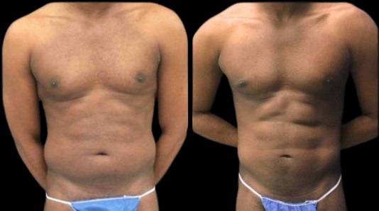 This is a 30-year-old male that has had an abdominal etching done showing the before and after's side-by-side