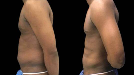 This is a 30-year-old male that has had an abdominal etching done showing the before and after's side-by-side