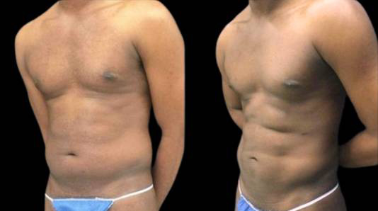 This is a 30-year-old male that has had an abdominal etching done showing the before and after's side-by-side
