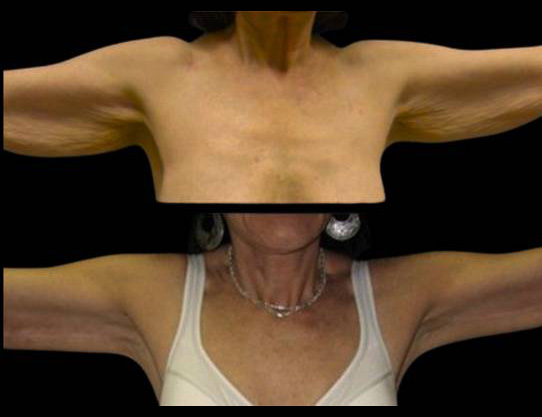 This is a 31-year-old female that has had an arm lift done showing the before and after's side-by-side