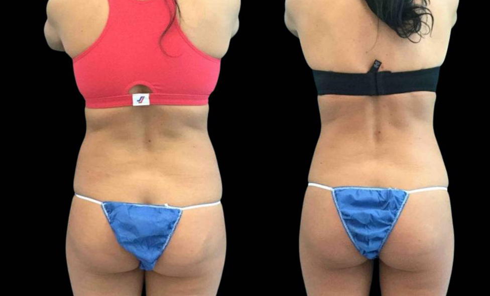 31-year-old-female-coolsculpting-before-and-after-back-view.jpg
