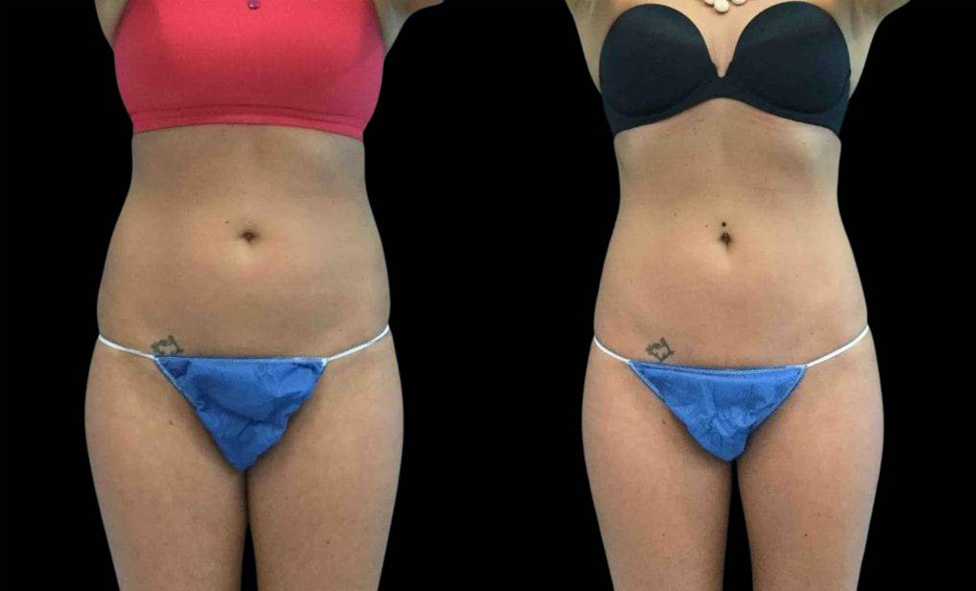 31-year-old-female-coolsculpting-before-and-after-front-view.jpg