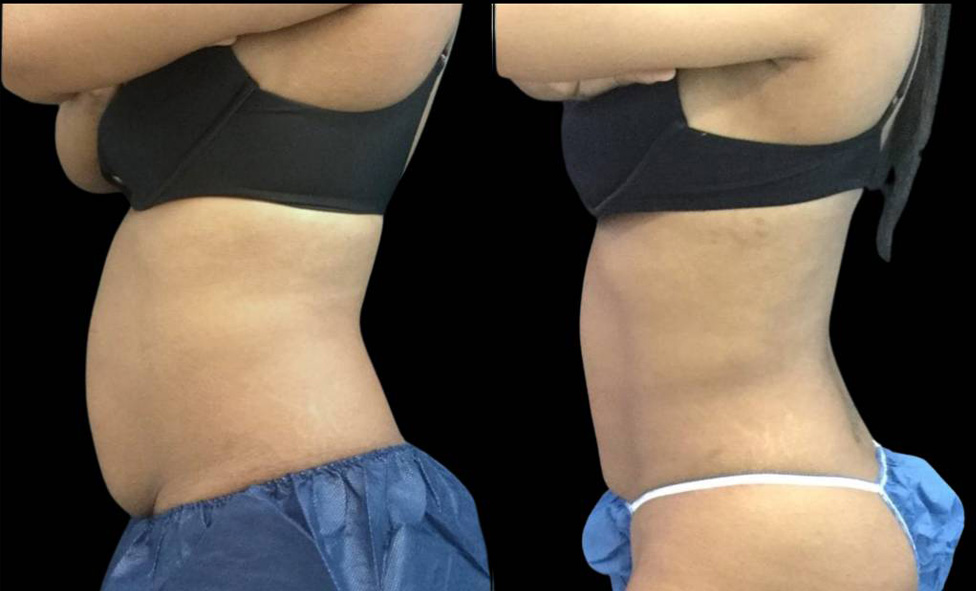 31-year-old-female-coolsculpting-before-and-after-side-view-1.jpg