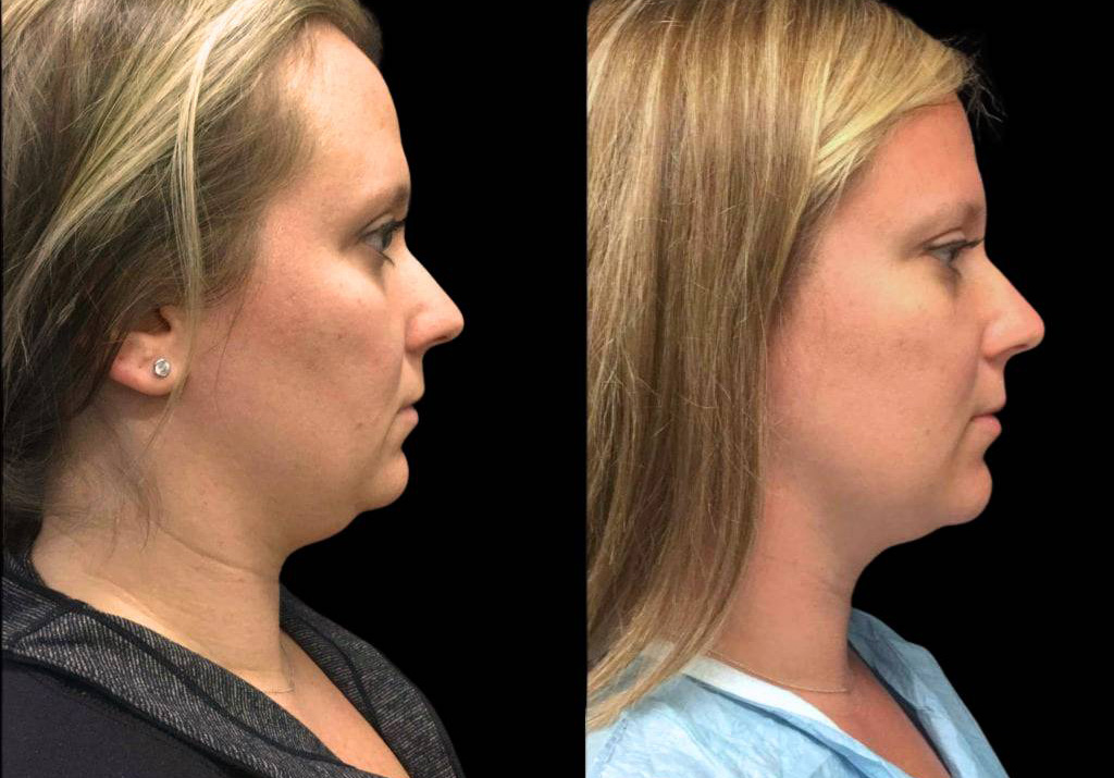 31-year-old-female-neck-liposuction-before-and-after-side-view-1.jpg