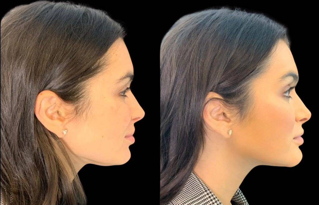 31-year-old-female-non-surgical-chin-augmentation-before-and-after-side-view.jpg
