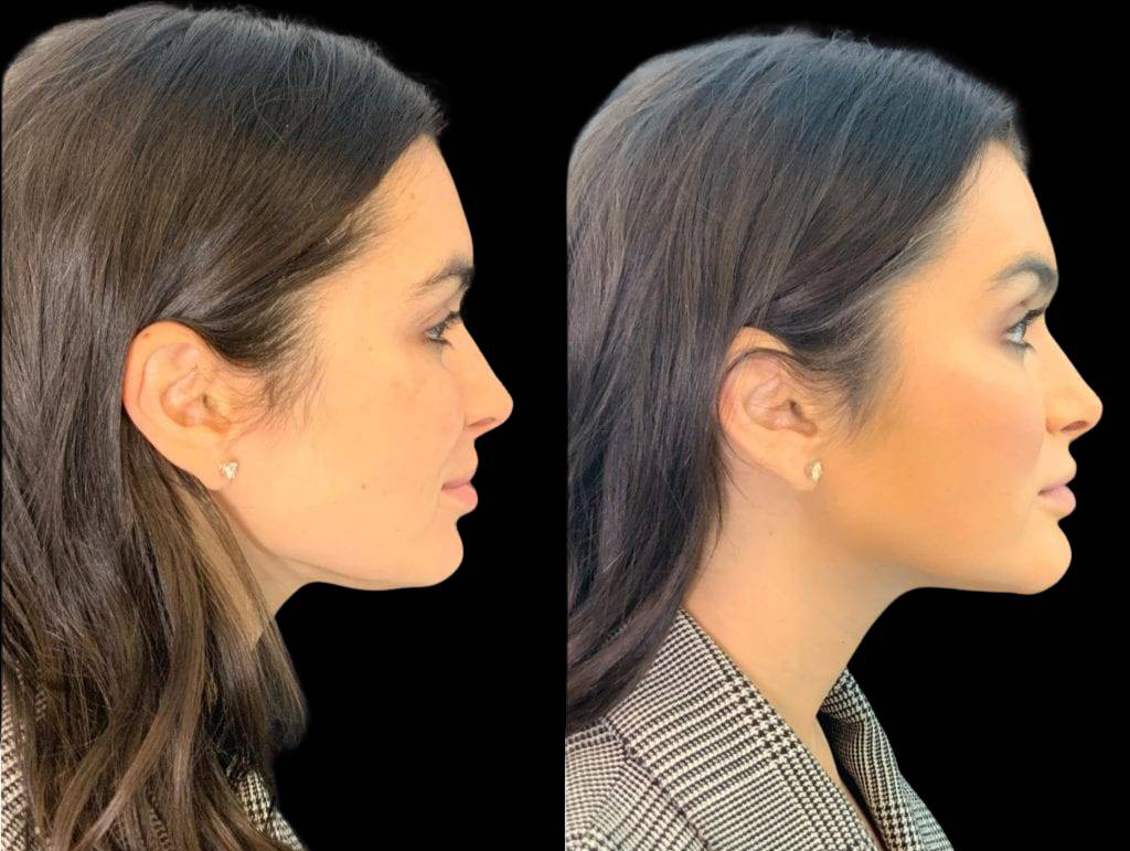 31-year-old-female-non-surgical-chin-augmentation-before-and-after-side-view.jpg