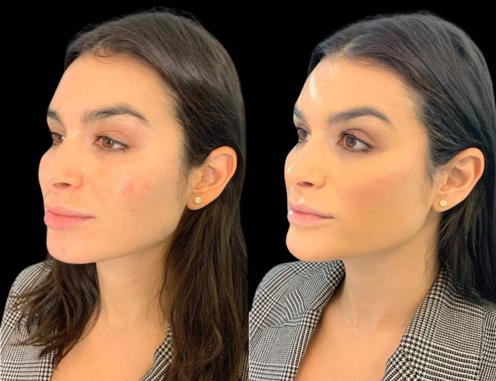 31-year-old-female-non-surgical-chin-augmentation-before-and-after-three-quarter-view.jpg