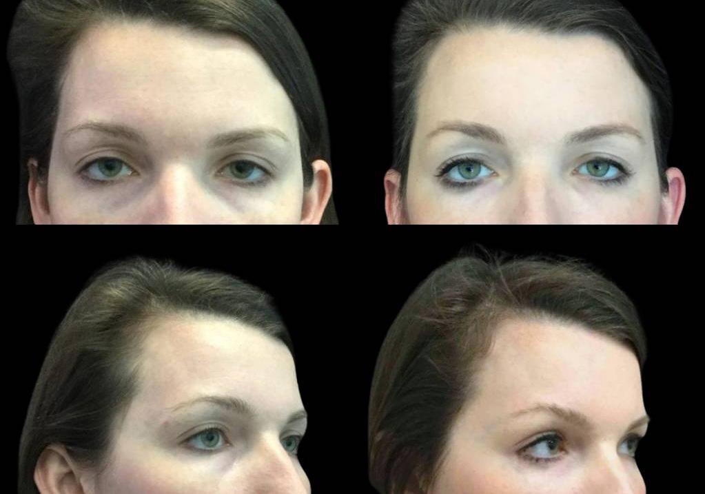 31-year-old-female-restylane-before-and-after-front-view-27266.jpg
