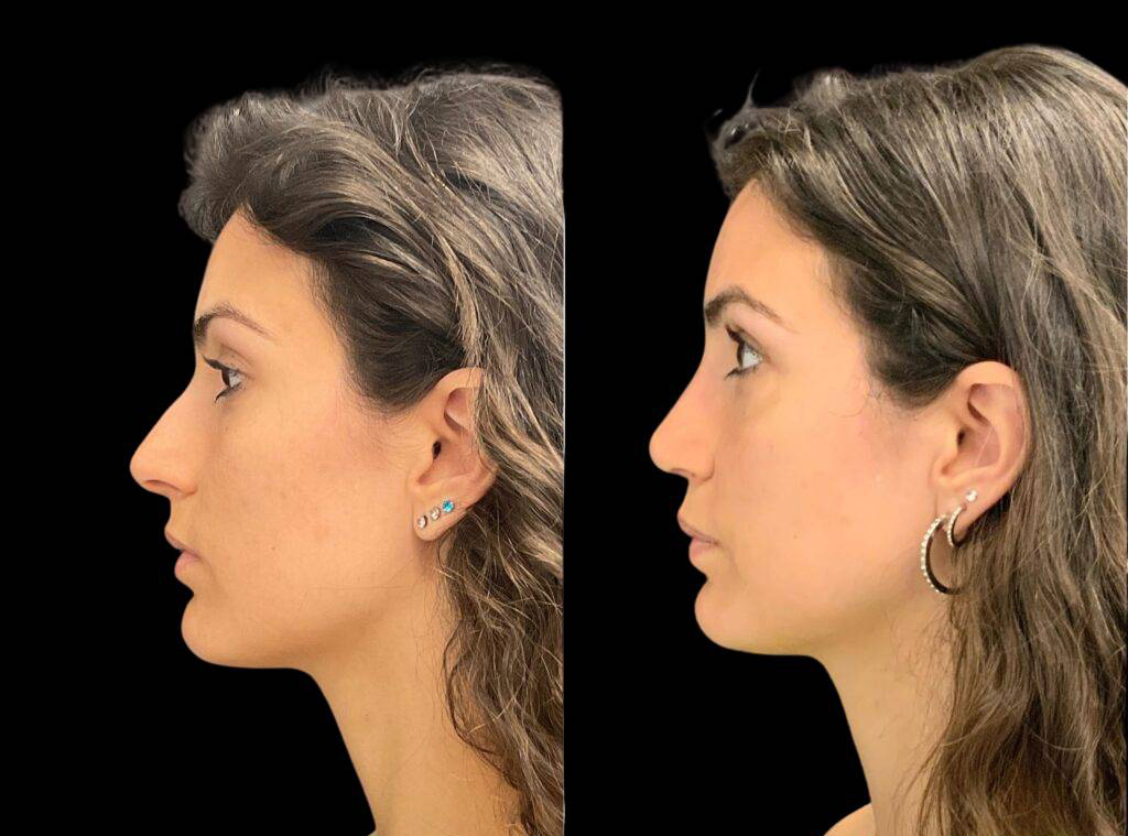 31-year-old-female-rhinoplasty-before-and-after-side-view.jpg