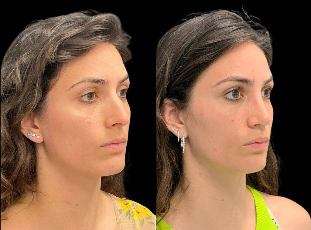 31-year-old-female-rhinoplasty-before-and-after-three-quarters-view-2.jpg