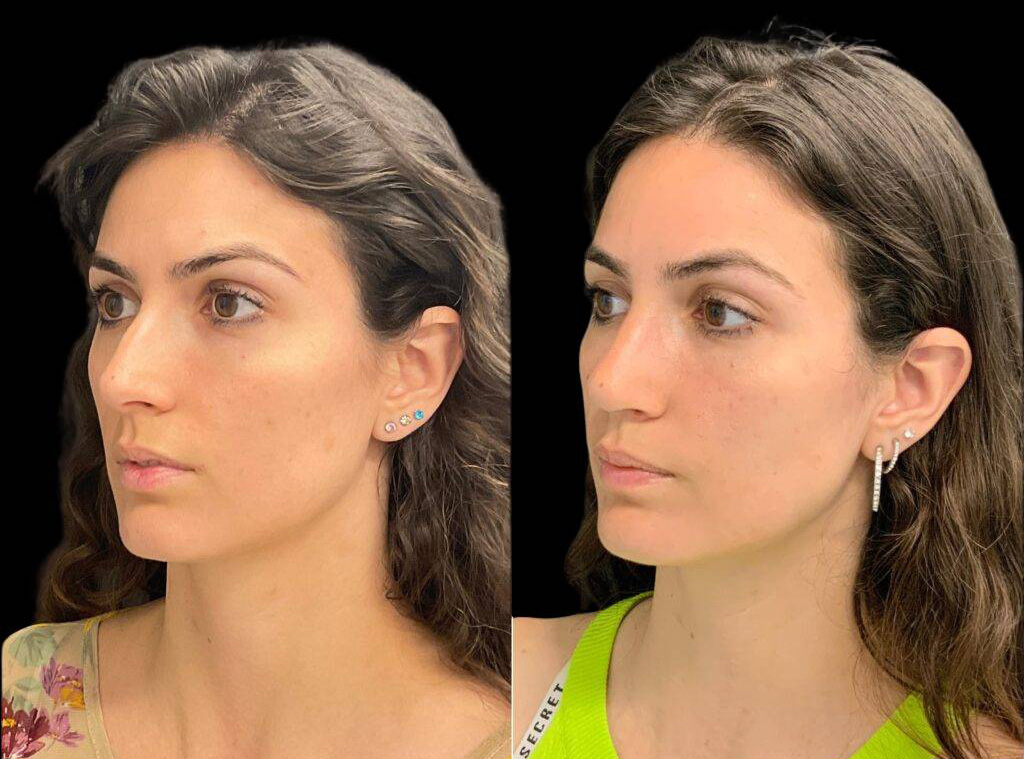 31-year-old-female-rhinoplasty-before-and-after-three-quarters-view.jpg