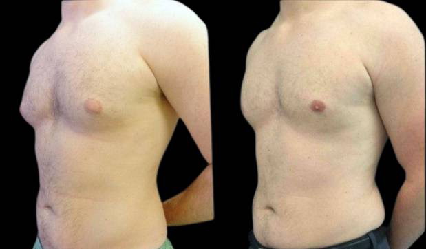 31-year-old-male-breast-reduction-before-and-after-three-quarters-view-16357.jpg