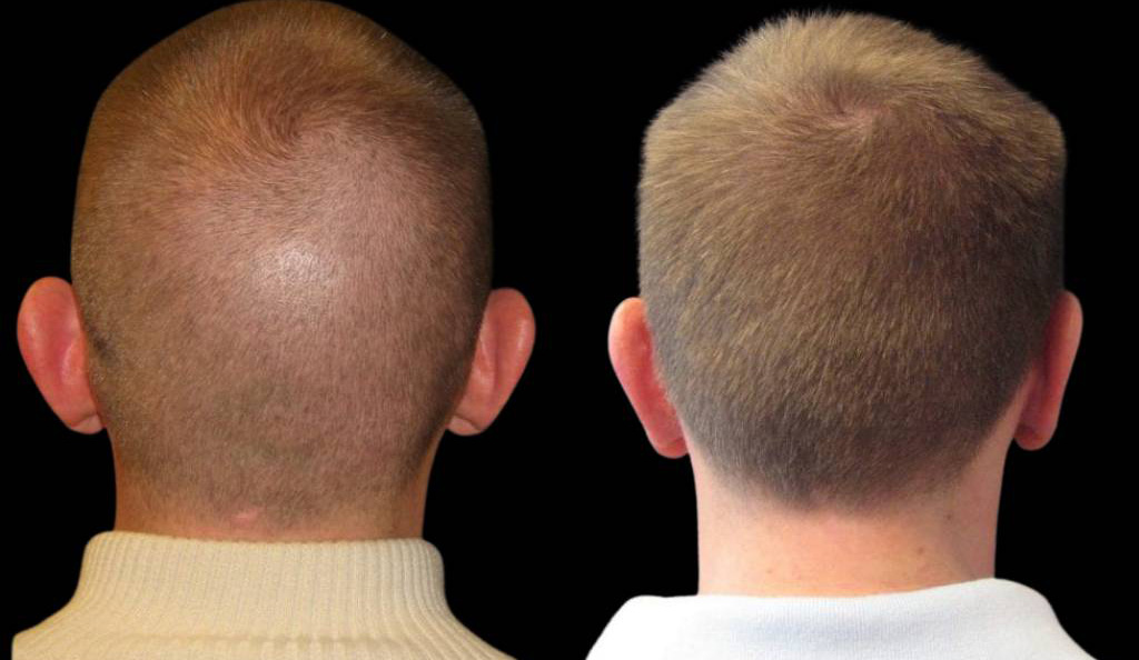31-year-old-male-ear-pinning-before-and-after-back-view.jpg