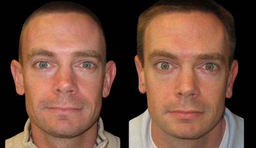 31-year-old-male-ear-pinning-before-and-after-front-view.jpg
