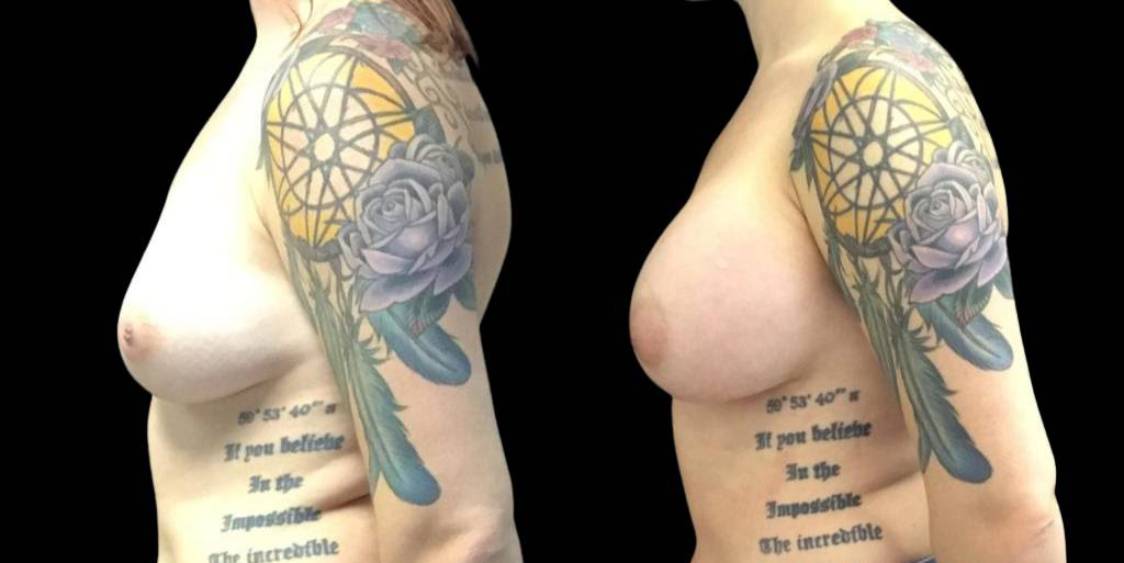 This is a 32-year-old female that has had a breast augmentation and implant showing the before and after's side-by-side