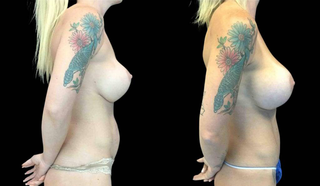 32-year-old-female-breast-implant-exchange-before-and-after-side-view.jpg