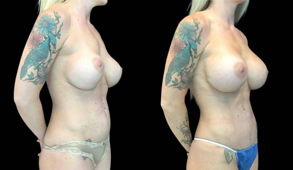 32-year-old-female-breast-implant-exchange-before-and-after-three-quarter-view.jpg