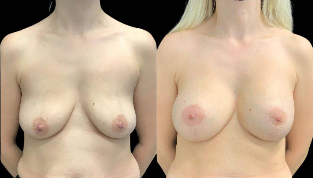 32-year-old-female-breast-lift-with-augmentation-before-and-after-front-view-32789.jpg