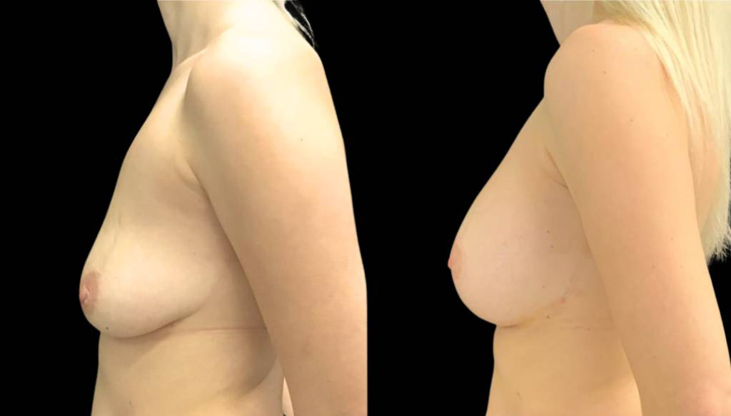 32-year-old-female-breast-lift-with-augmentation-before-and-after-side-view.jpg