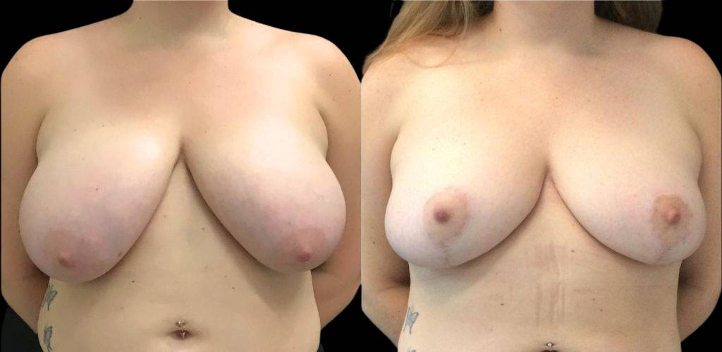 32-year-old-female-breast-reduction-before-and-after-front-view.jpg