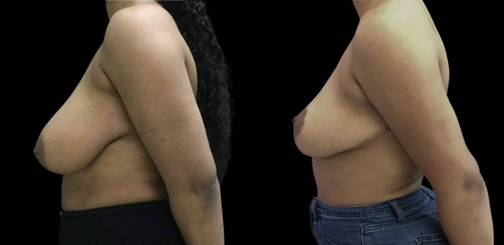 32-year-old-female-breast-reduction-before-and-after-side-view.jpg