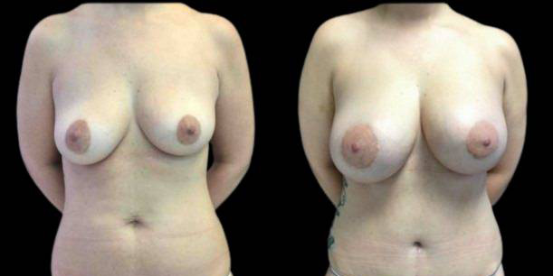 This is a 32-year-old female that has had a mommy makeover showing the before and after's side-by-side