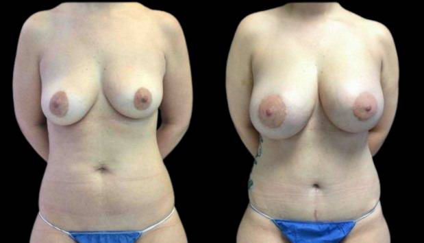 32-year-old-female-mommy-makeover-body-before-and-after-front-view-19182.jpg